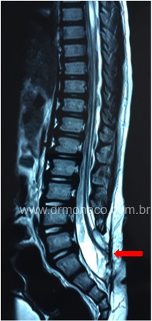 Ressonância Magnética mostrando uma medula presa no nível sacral (seta vermelha), em região onde há falha de fechamento da coluna vertebral (paciente com mielomeningocele). Dr Bernardo de Monaco. 