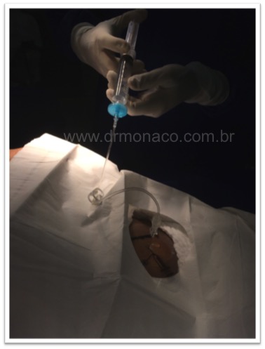 Baclofen Pump Refill - Dr Bernardo de Monaco - Medtronic Synchromed 2 - Spasticity