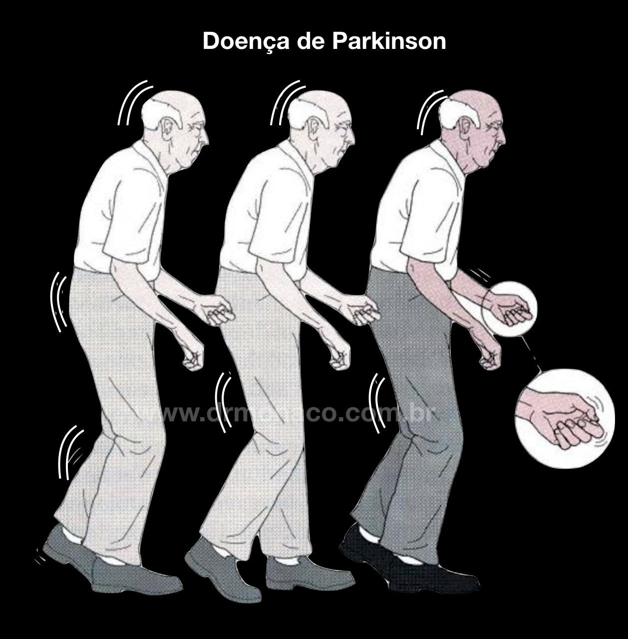 doença de Parkinson; tremor; rigidez; estimulação cerebral profunda; cirurgia para Parkinson