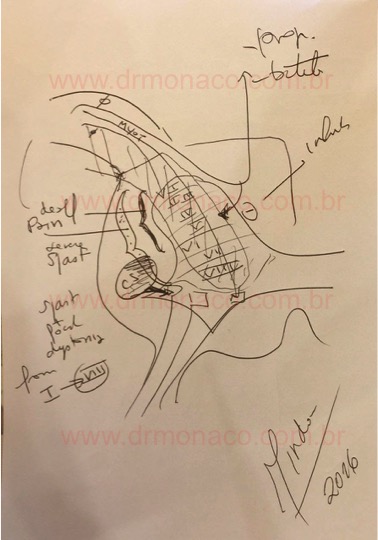 DREZ; DREZotomy; Lissauer Tractotomy; Tractotomia de Lissauer; Lesão da Zona de Entrada da Raiz Dorsal; DREZotomia