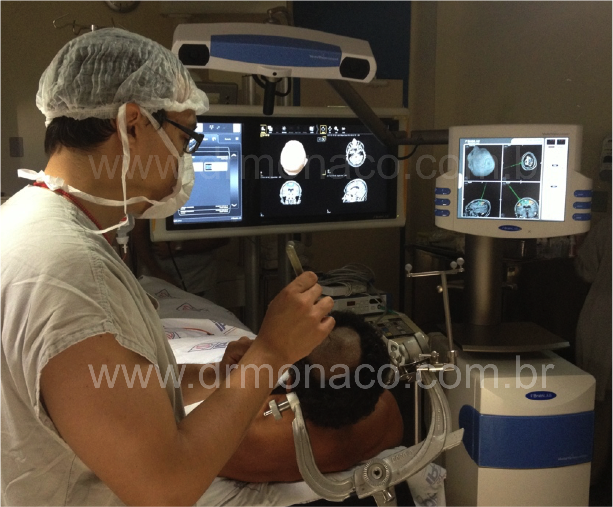 Estimulacao Cortica; Motor Cortex Stimulation; Dr Bernardo de Monaco; Pain Treatment; Tratamento de Dor; Neurocirurgia Funcional; Functional Neurosurgery