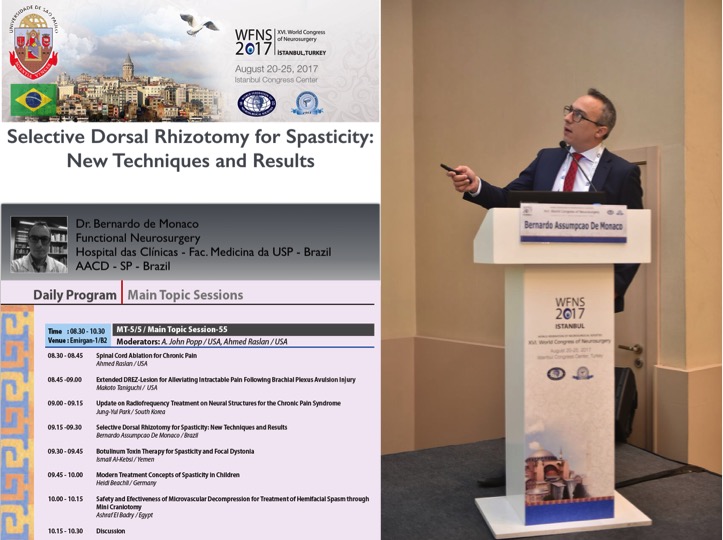 Dr. Bernardo de Monaco ministra aula sobre Rizotomia Dorsal Seletiva no Congresso Mundial de Neurocirurgia - XVI WFNS - em 2017 - na Turquia. Dr Bernardo de Monaco; Congresso Mundial de Neurocirurgia; WFNS; Rizotomia Dorsal Seletiva; Selective Dorsal Rhizotomy